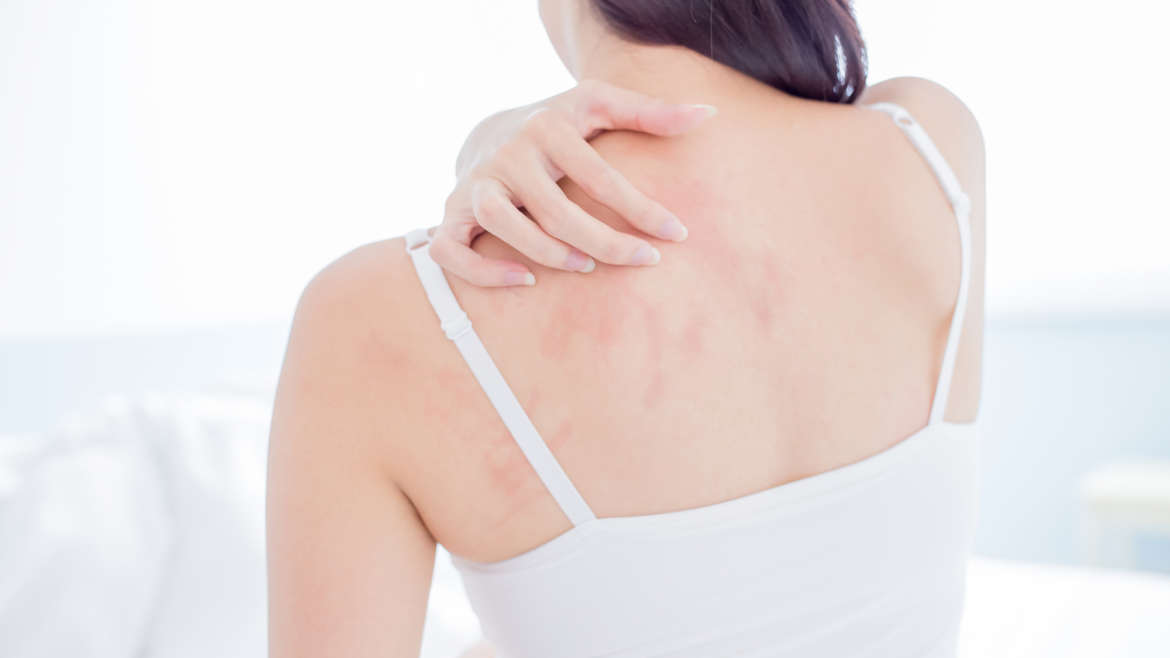 Eczema Diagnosis & Treatment